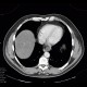 Mediastinal cyst: CT - Computed tomography